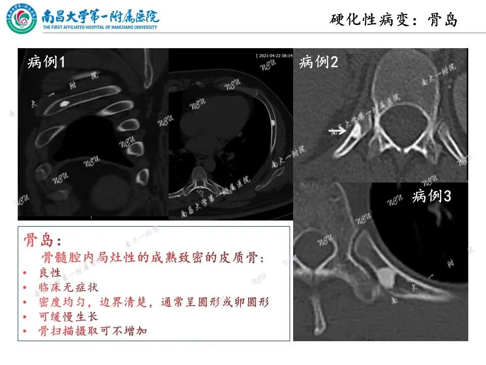 影像PPT - 【PPT】非创伤性肋骨病变及影像诊断思路-28
