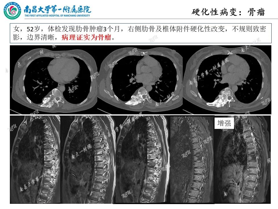 影像PPT - 【PPT】非创伤性肋骨病变及影像诊断思路-29