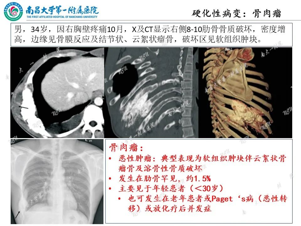 影像PPT - 【PPT】非创伤性肋骨病变及影像诊断思路-30