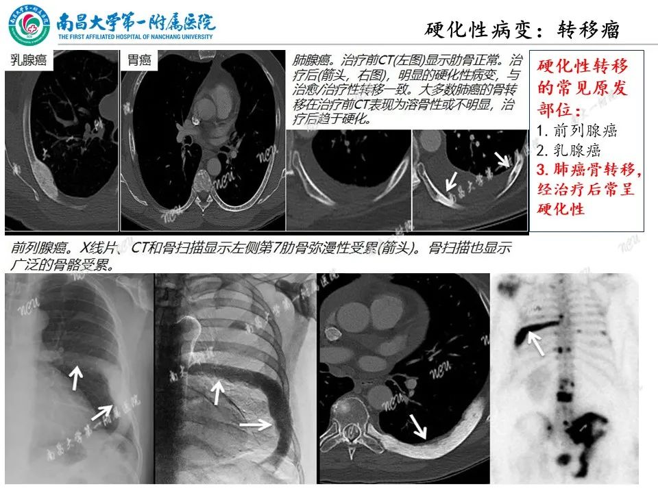 影像PPT - 【PPT】非创伤性肋骨病变及影像诊断思路-32