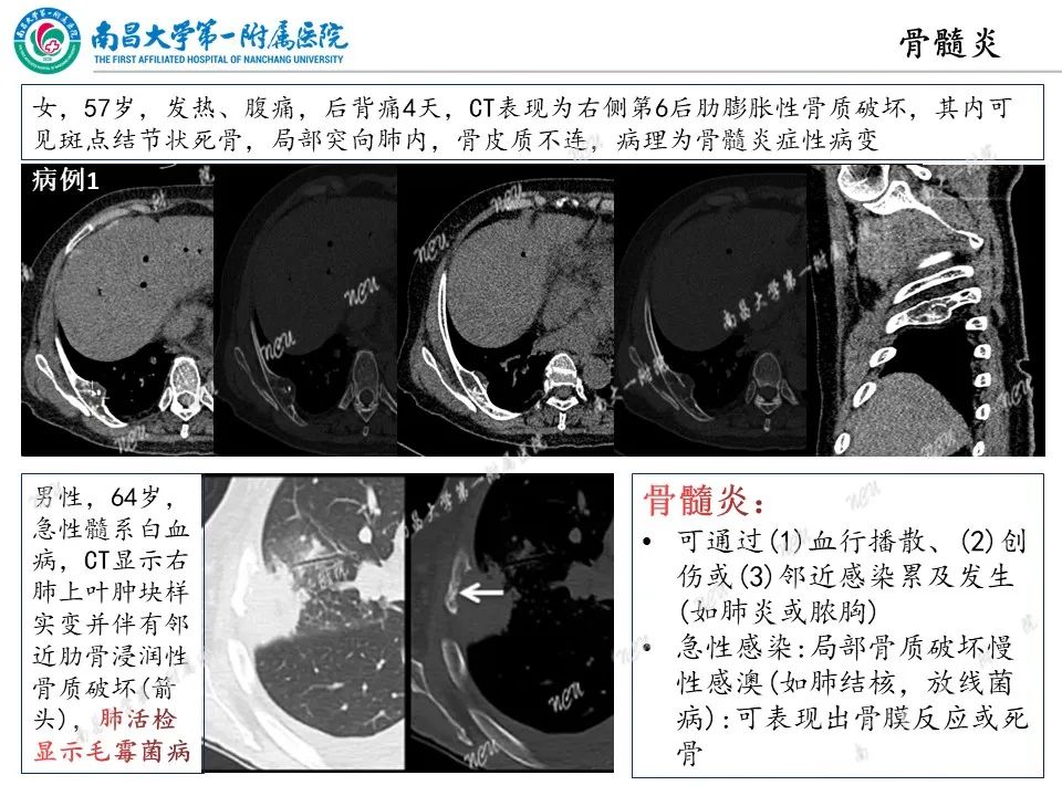 影像PPT - 【PPT】非创伤性肋骨病变及影像诊断思路-33