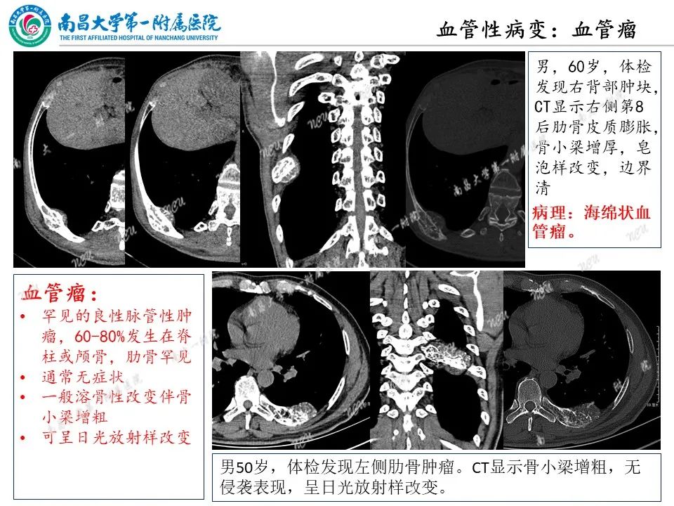 影像PPT - 【PPT】非创伤性肋骨病变及影像诊断思路-35