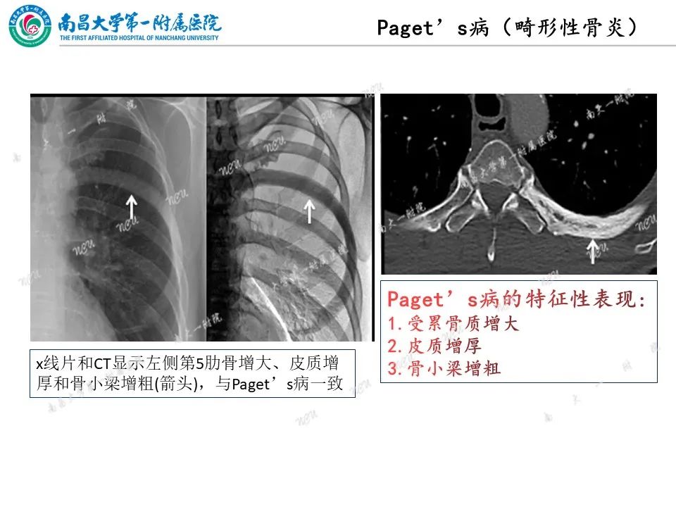 影像PPT - 【PPT】非创伤性肋骨病变及影像诊断思路-36