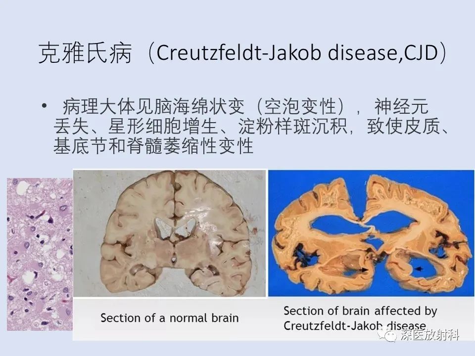 影像PPT - 【病例】克雅氏病1例MR影像诊断-8