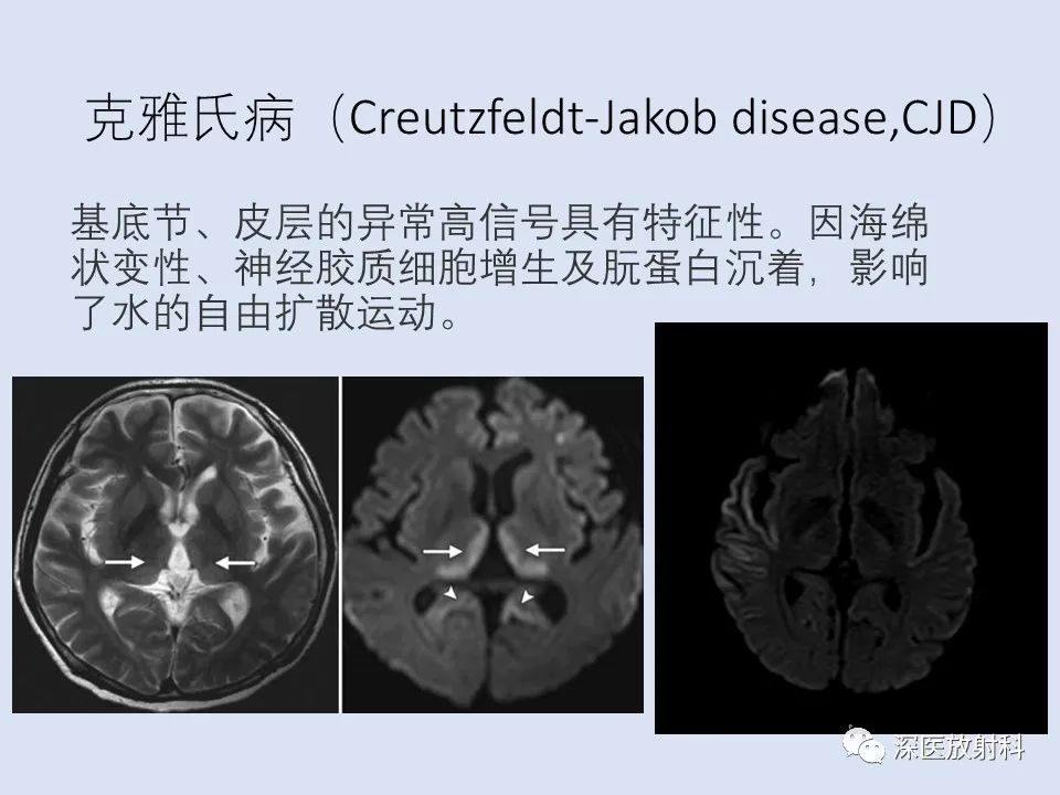 影像PPT - 【病例】克雅氏病1例MR影像诊断-10