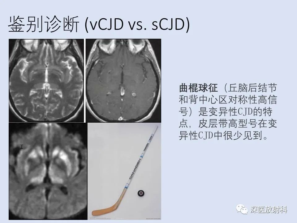 影像PPT - 【病例】克雅氏病1例MR影像诊断-14