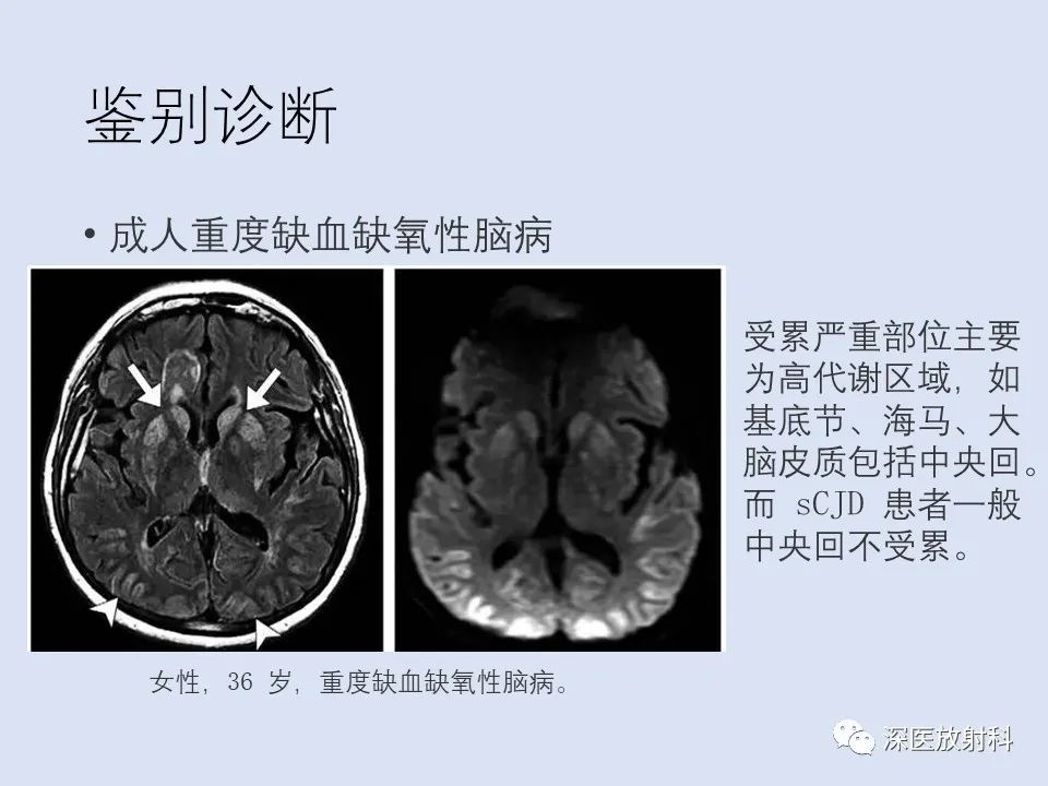 影像PPT - 【病例】克雅氏病1例MR影像诊断-15