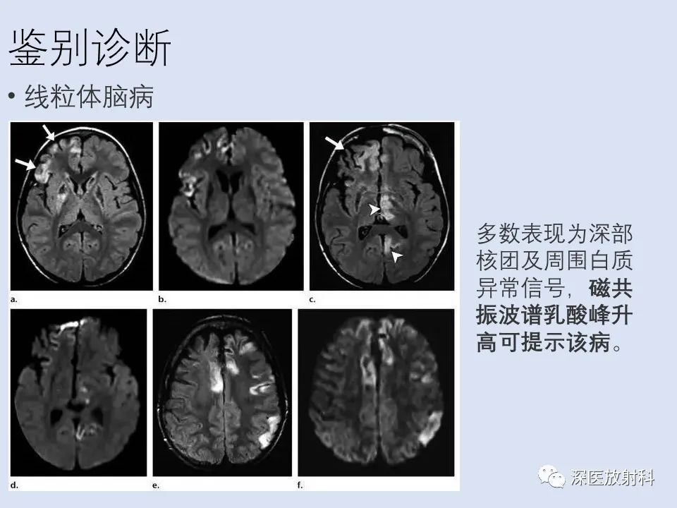 影像PPT - 【病例】克雅氏病1例MR影像诊断-18