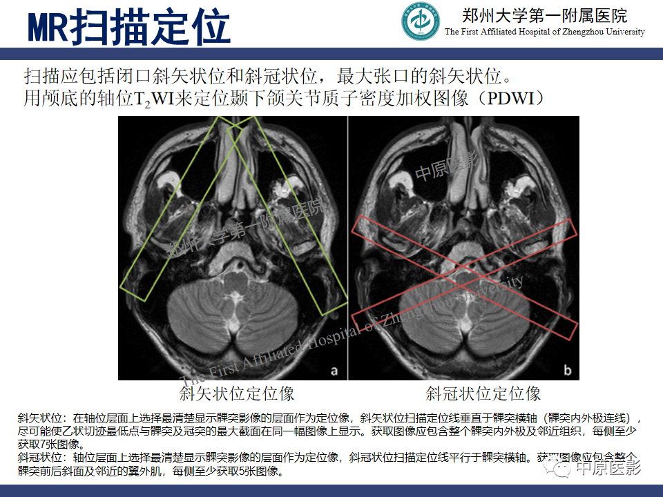 影像PPT - 【PPT】颞颌关节紊乱病的MRI诊断-24