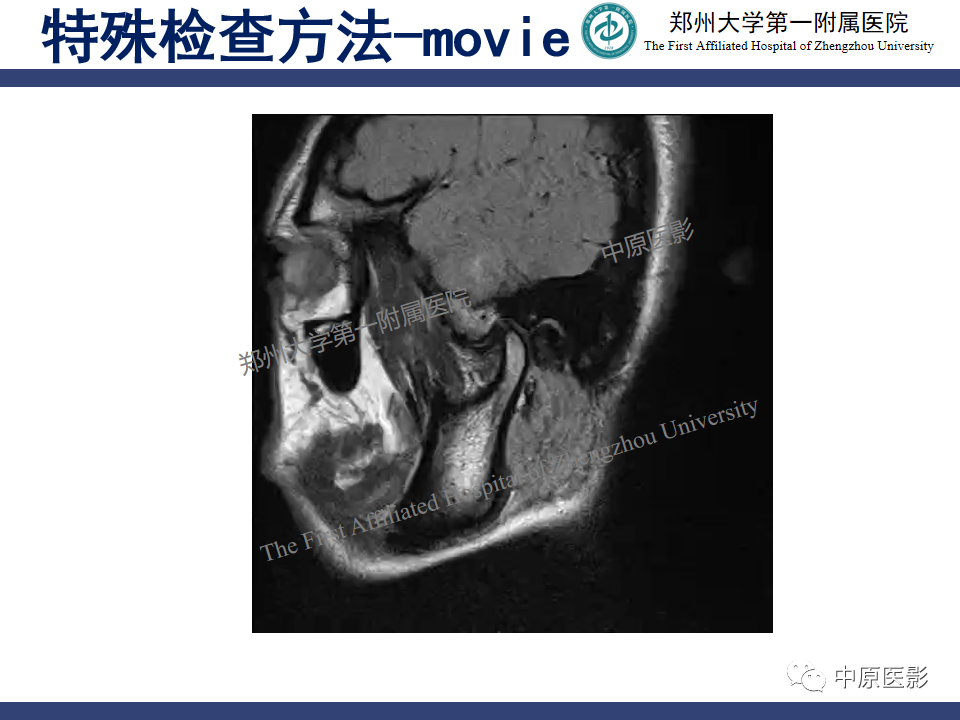 影像PPT - 【PPT】颞颌关节紊乱病的MRI诊断-28