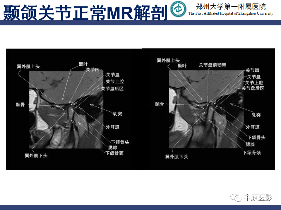 影像PPT - 【PPT】颞颌关节紊乱病的MRI诊断-31