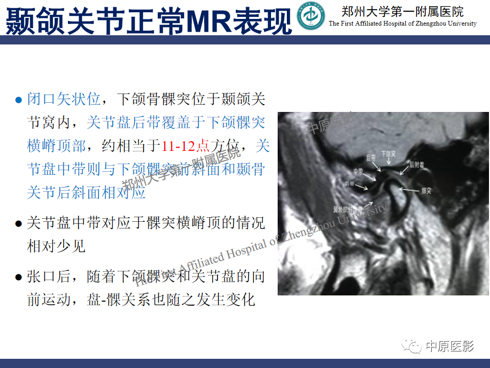 影像PPT - 【PPT】颞颌关节紊乱病的MRI诊断-33