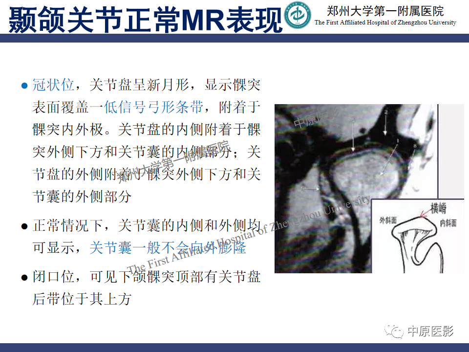 影像PPT - 【PPT】颞颌关节紊乱病的MRI诊断-34