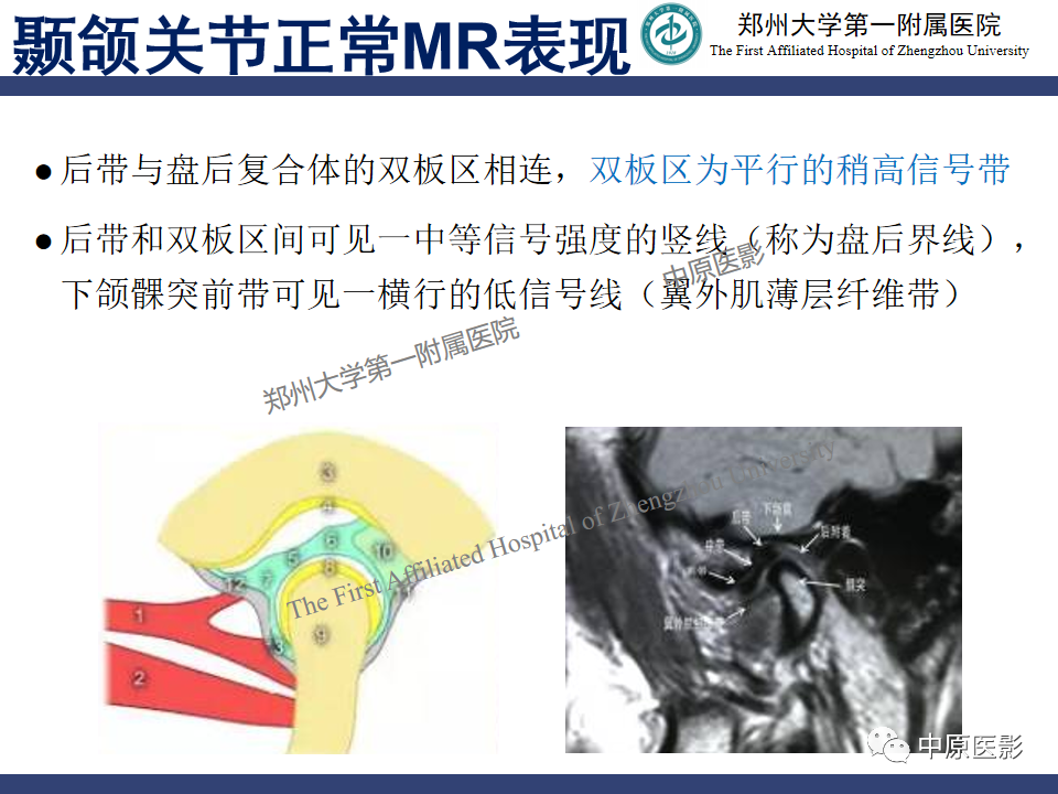 影像PPT - 【PPT】颞颌关节紊乱病的MRI诊断-37