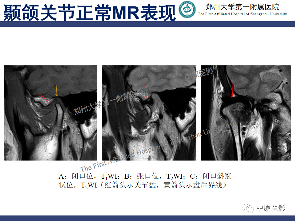 影像PPT - 【PPT】颞颌关节紊乱病的MRI诊断-38