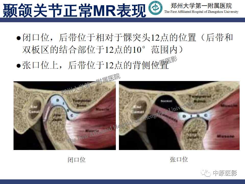 影像PPT - 【PPT】颞颌关节紊乱病的MRI诊断-39