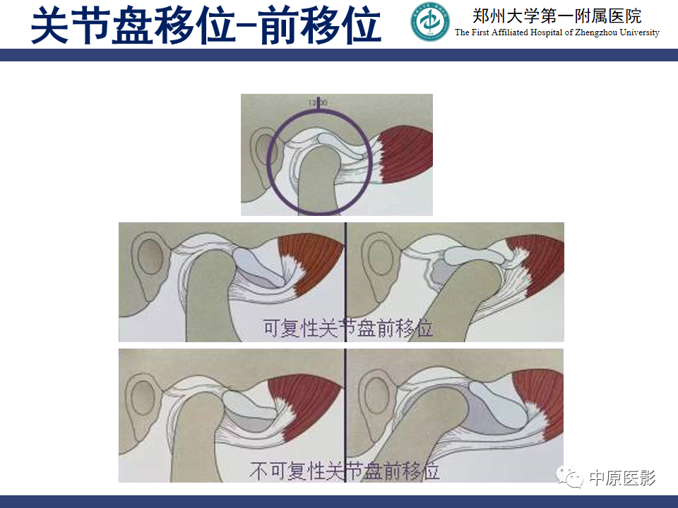 影像PPT - 【PPT】颞颌关节紊乱病的MRI诊断-50