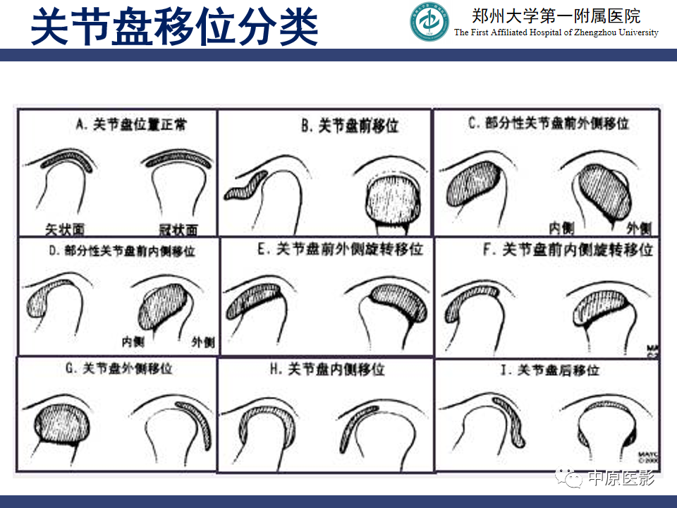 影像PPT - 【PPT】颞颌关节紊乱病的MRI诊断-49