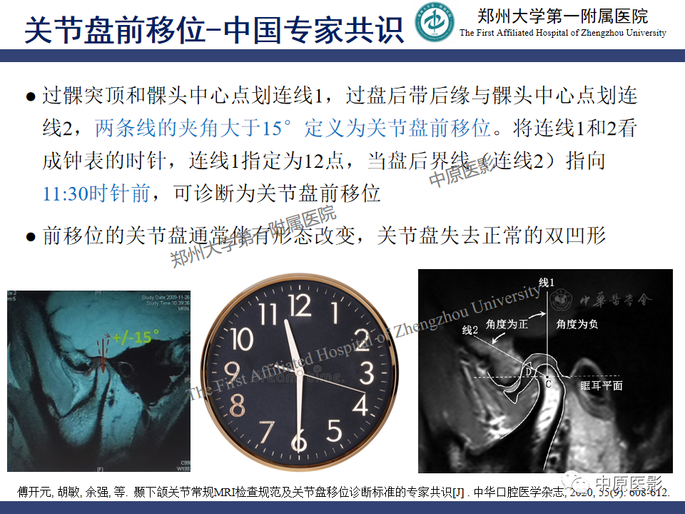影像PPT - 【PPT】颞颌关节紊乱病的MRI诊断-52