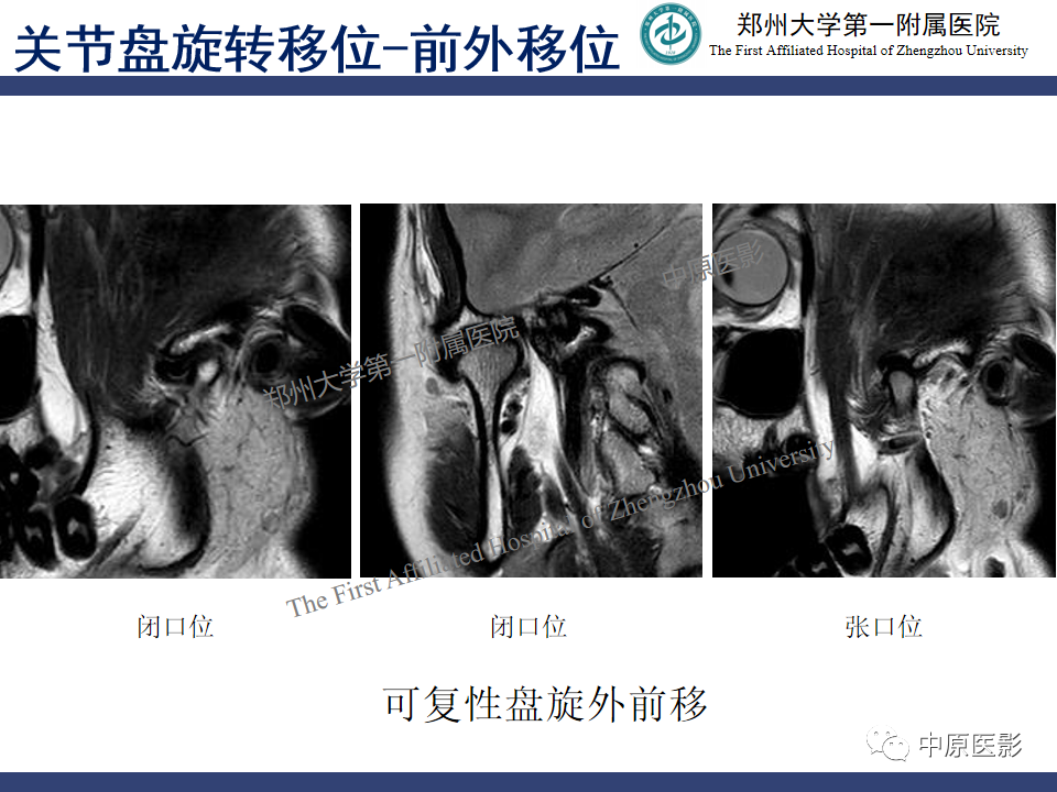 影像PPT - 【PPT】颞颌关节紊乱病的MRI诊断-60