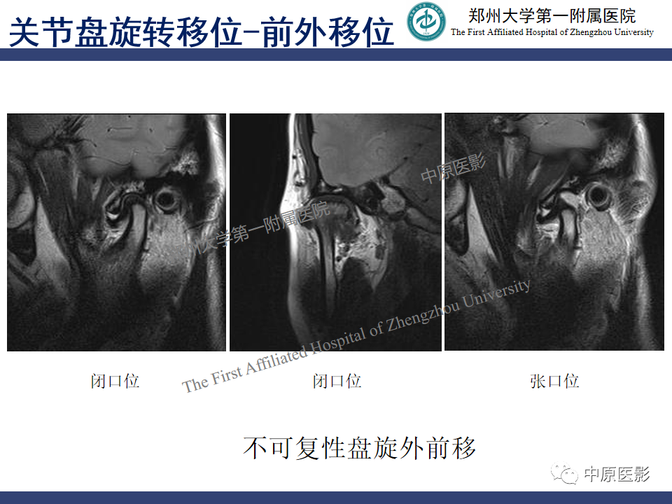 影像PPT - 【PPT】颞颌关节紊乱病的MRI诊断-61