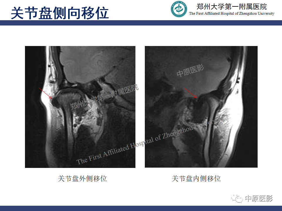 影像PPT - 【PPT】颞颌关节紊乱病的MRI诊断-58