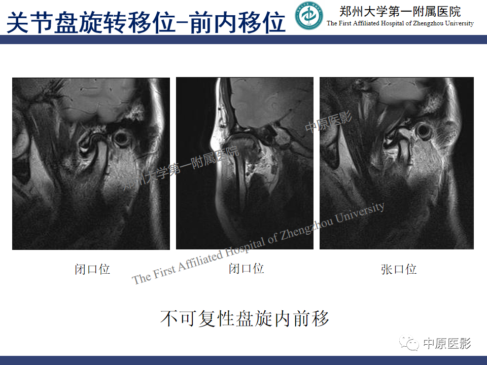 影像PPT - 【PPT】颞颌关节紊乱病的MRI诊断-63