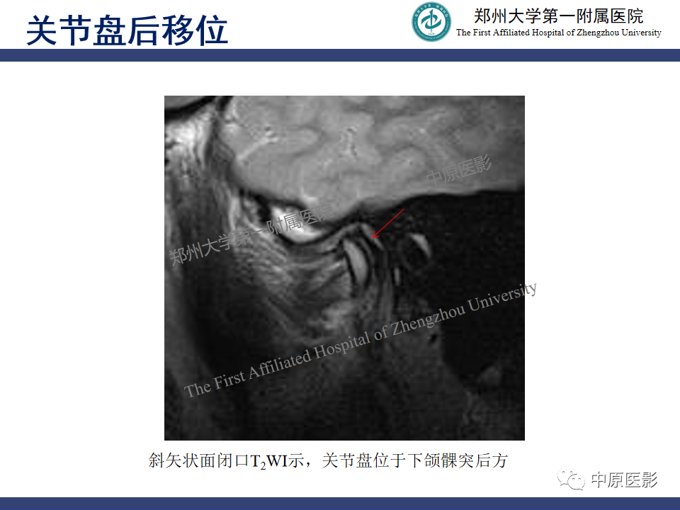 影像PPT - 【PPT】颞颌关节紊乱病的MRI诊断-65