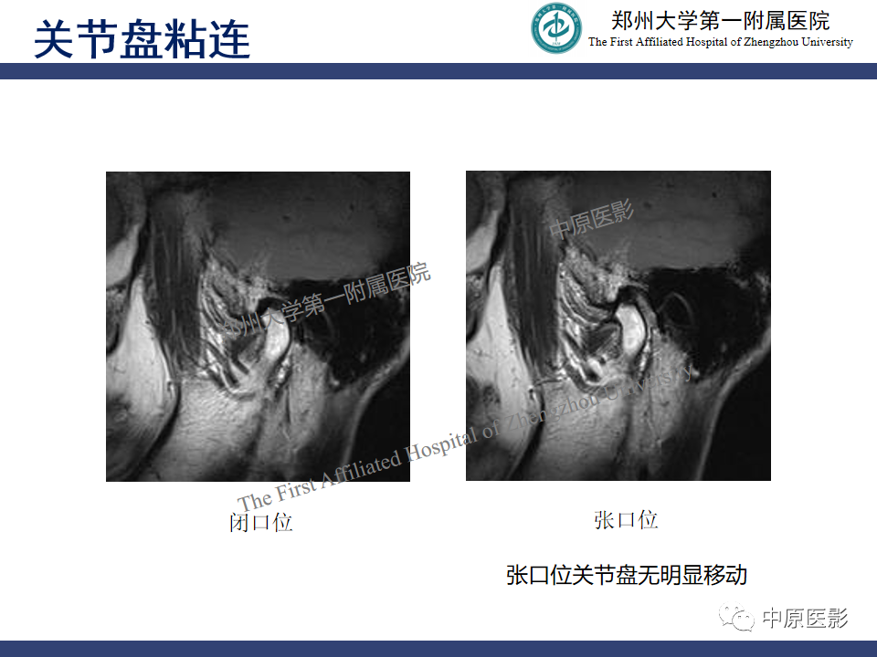 影像PPT - 【PPT】颞颌关节紊乱病的MRI诊断-71