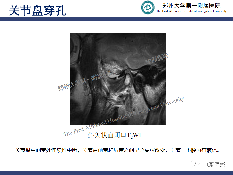 影像PPT - 【PPT】颞颌关节紊乱病的MRI诊断-72