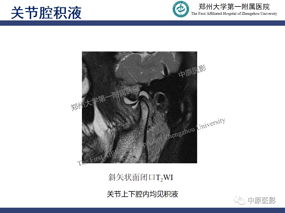 影像PPT - 【PPT】颞颌关节紊乱病的MRI诊断-74