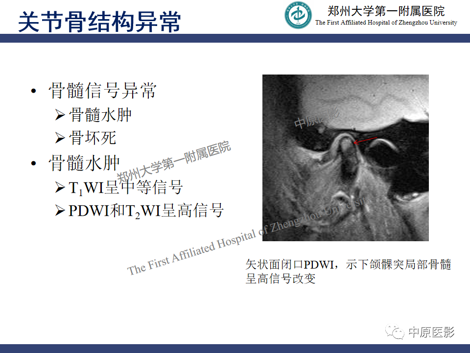 影像PPT - 【PPT】颞颌关节紊乱病的MRI诊断-78