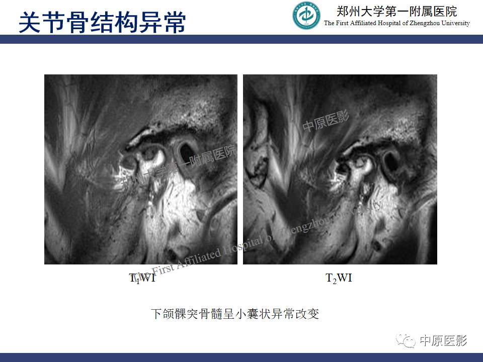 影像PPT - 【PPT】颞颌关节紊乱病的MRI诊断-77