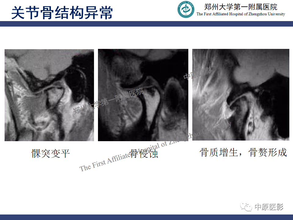 影像PPT - 【PPT】颞颌关节紊乱病的MRI诊断-79