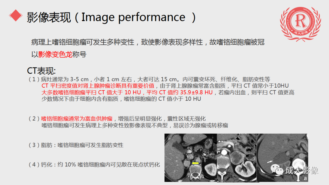 影像PPT - 【PPT】肾上腺嗜铬细胞瘤的CT及MRI表现-14