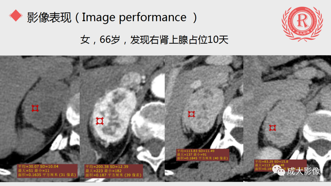 影像PPT - 【PPT】肾上腺嗜铬细胞瘤的CT及MRI表现-17