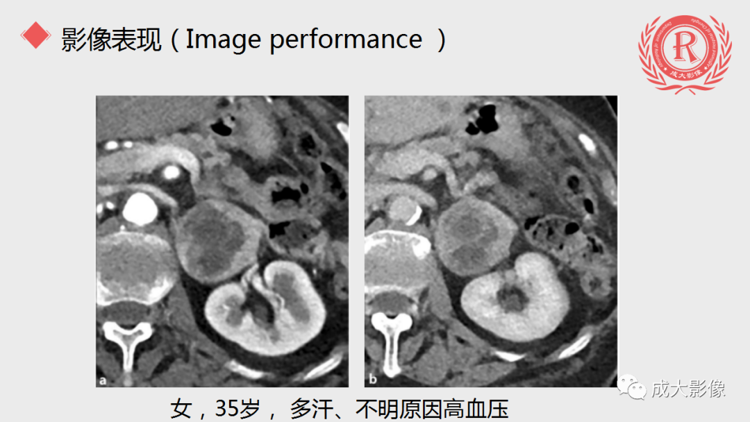 影像PPT - 【PPT】肾上腺嗜铬细胞瘤的CT及MRI表现-18