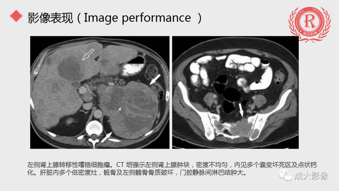 影像PPT - 【PPT】肾上腺嗜铬细胞瘤的CT及MRI表现-19