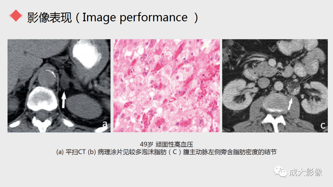 影像PPT - 【PPT】肾上腺嗜铬细胞瘤的CT及MRI表现-22