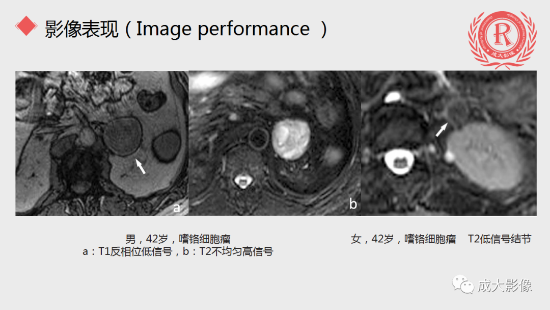 影像PPT - 【PPT】肾上腺嗜铬细胞瘤的CT及MRI表现-24