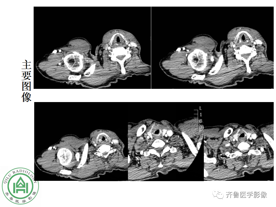 影像PPT - 【PPT】喉癌的定位、诊断及鉴别诊断-3