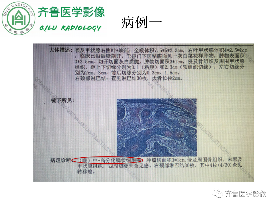 影像PPT - 【PPT】喉癌的定位、诊断及鉴别诊断-6