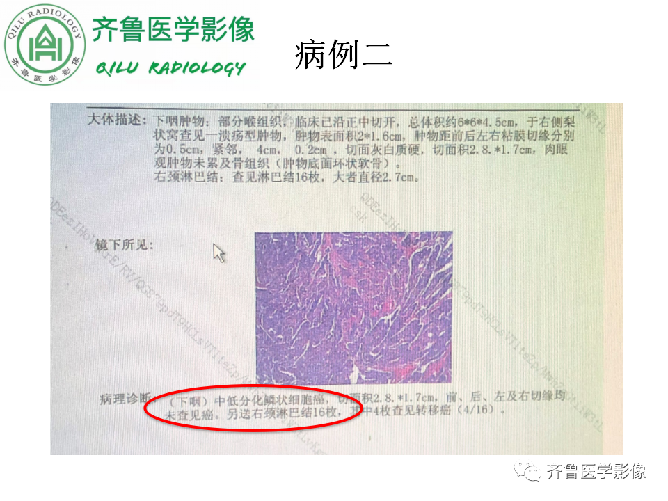 影像PPT - 【PPT】喉癌的定位、诊断及鉴别诊断-7