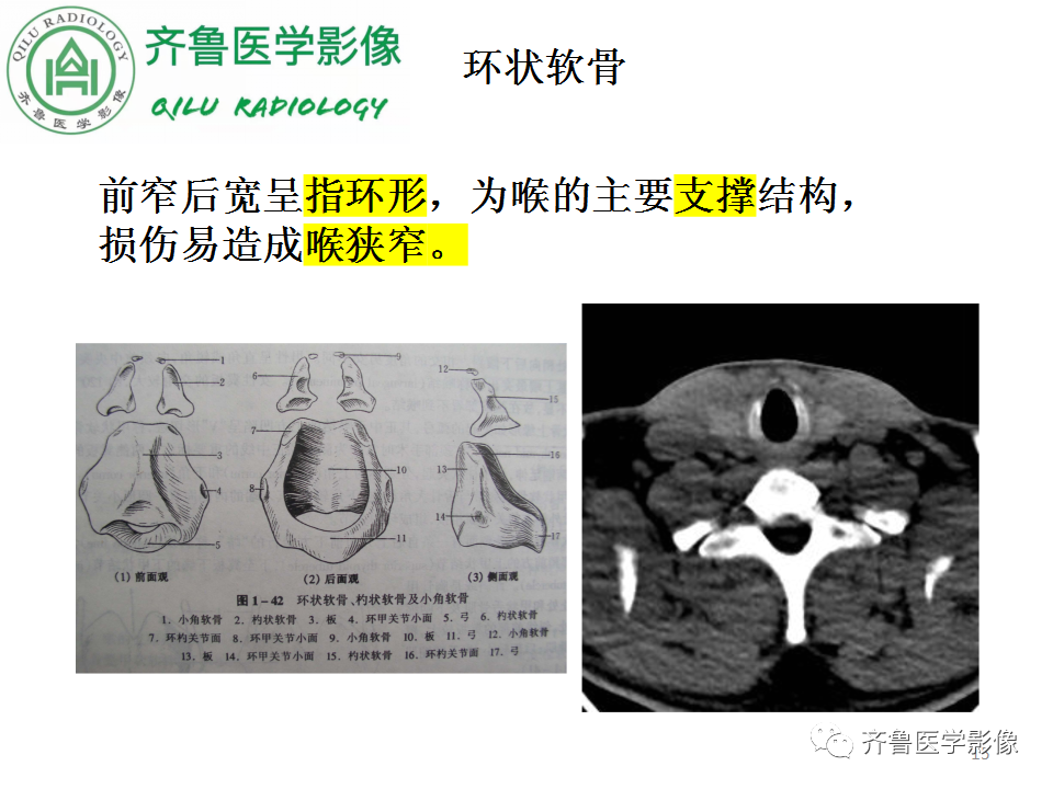影像PPT - 【PPT】喉癌的定位、诊断及鉴别诊断-15