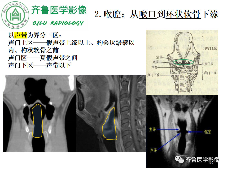 影像PPT - 【PPT】喉癌的定位、诊断及鉴别诊断-16