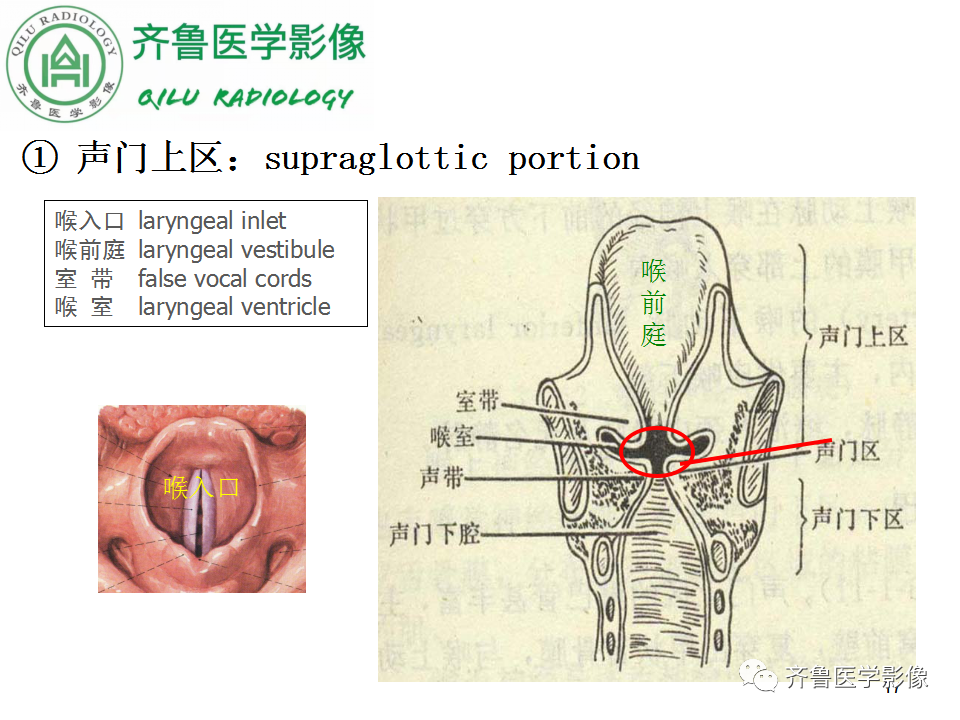 影像PPT - 【PPT】喉癌的定位、诊断及鉴别诊断-17