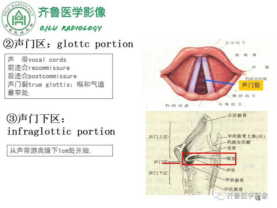 影像PPT - 【PPT】喉癌的定位、诊断及鉴别诊断-18