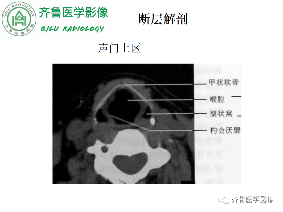 影像PPT - 【PPT】喉癌的定位、诊断及鉴别诊断-19