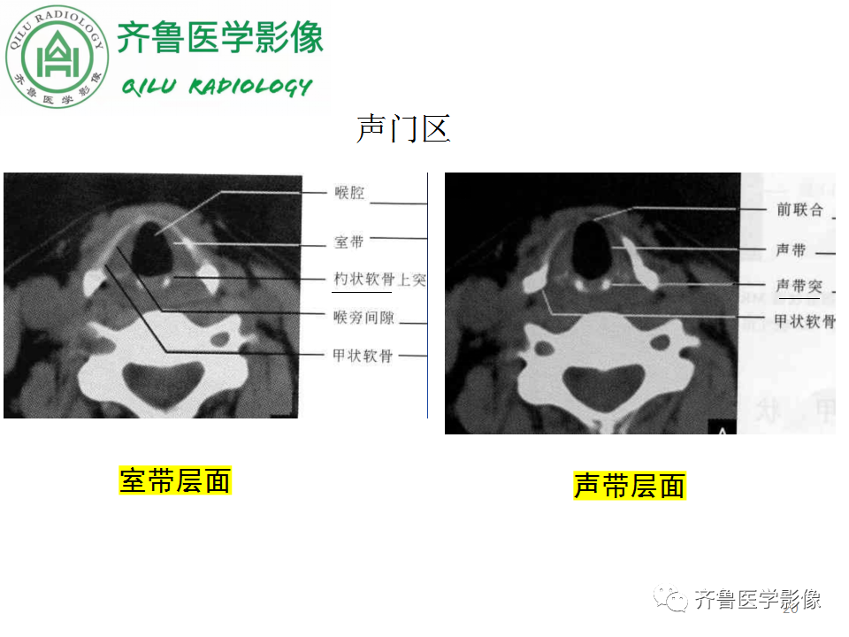 影像PPT - 【PPT】喉癌的定位、诊断及鉴别诊断-20