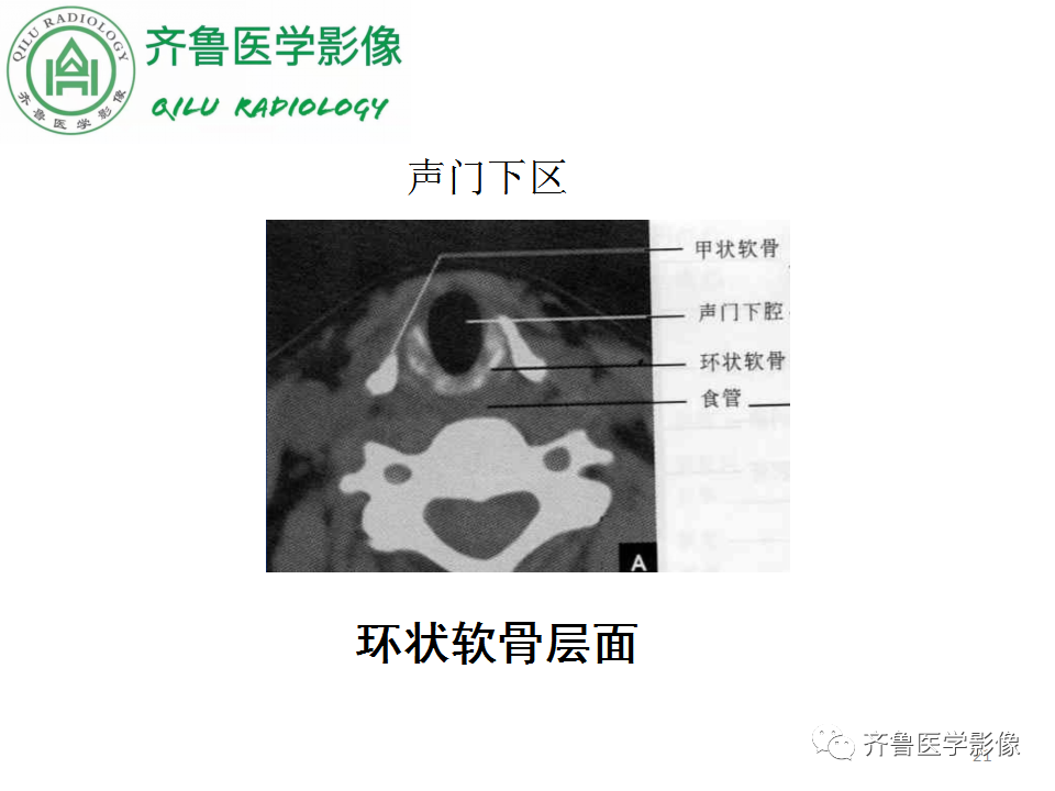 影像PPT - 【PPT】喉癌的定位、诊断及鉴别诊断-21
